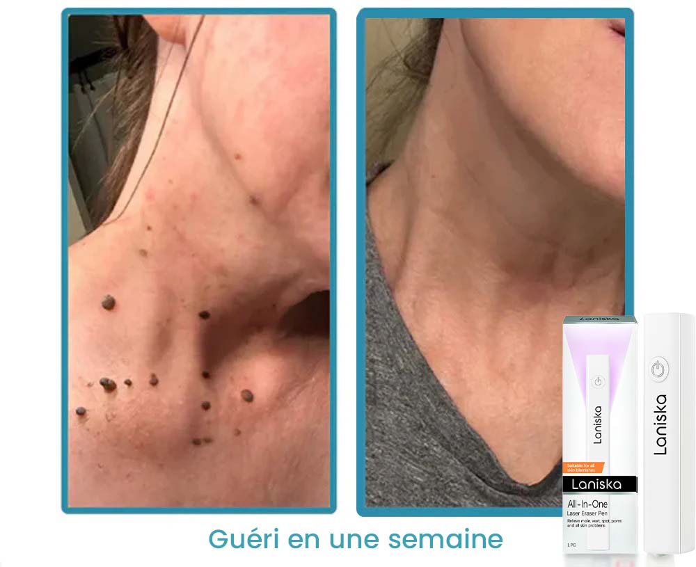 Stylo Effaceur Laser Eliminine les grains de Beauté, les Verrues, les Imperfections cutanées et la Pigmentation